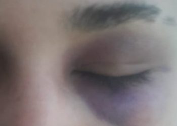 Mulher agredida no Pingo da Mei Dia em Mossoró diz que a única explicação é homofobia