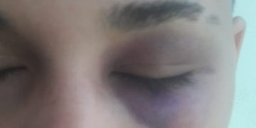 Mulher agredida no Pingo da Mei Dia em Mossoró diz que a única explicação é homofobia