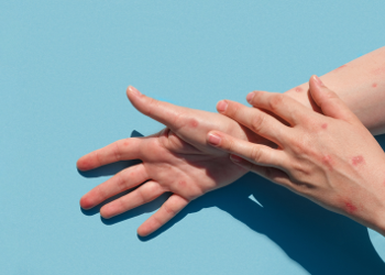 Confirmado caso de Monkeypox em Mossoró; Homem de 48 anos tem histórico de viagem para SP