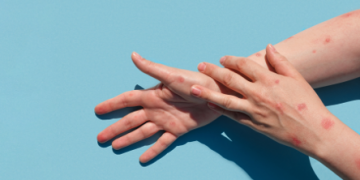 Confirmado caso de Monkeypox em Mossoró; Homem de 48 anos tem histórico de viagem para SP