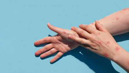 Confirmado caso de Monkeypox em Mossoró; Homem de 48 anos tem histórico de viagem para SP