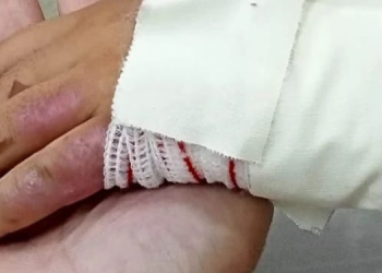 Pacientes queimados do interior precisam ir para capital em busca de tratamento