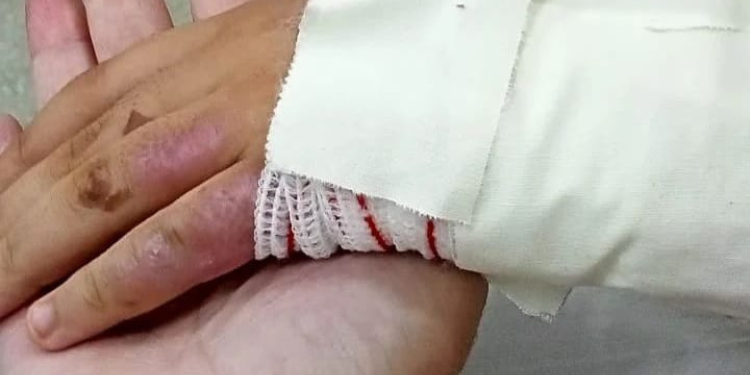 Pacientes queimados do interior precisam ir para capital em busca de tratamento