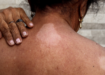 Hanseníase: dos desafios do preconceito à busca do tratamento