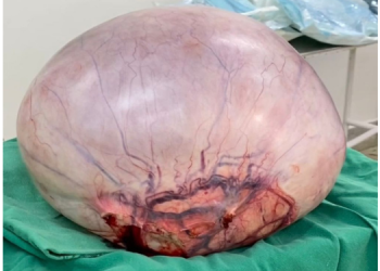 Médicos retiram tumor de 10kg de paciente que esperava por cirurgia há dois anos