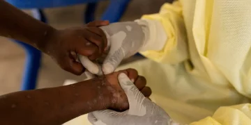 Saúde negocia compra de 25 mil doses de vacina contra mpox