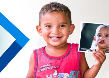 Tem início cadastro para pessoas com fissura labiopalatina poderem realizar a cirurgia gratuitamente