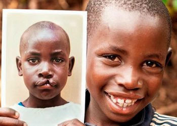 Lula sanciona lei que obriga cirurgia de fissura labiopalatina no SUS