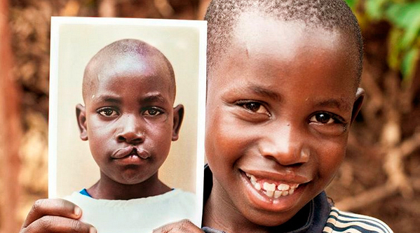 Lula sanciona lei que obriga cirurgia de fissura labiopalatina no SUS